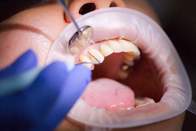 Eigentliche-Parodontitistherapie