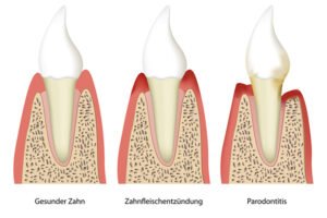 Parodontitis-zahnfleischentzuendung-Zahnarzt-Nadjar.