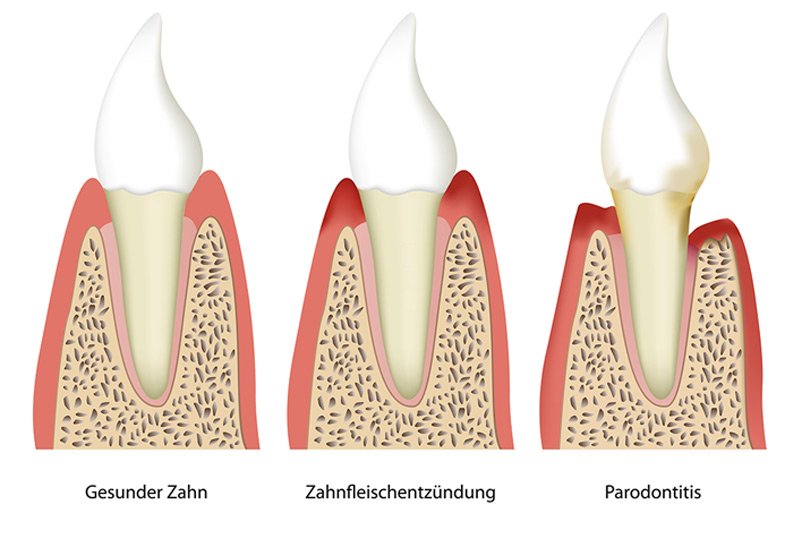 Parodontitis-zahnfleischentzuendung-Zahnarzt-Nadjar.
