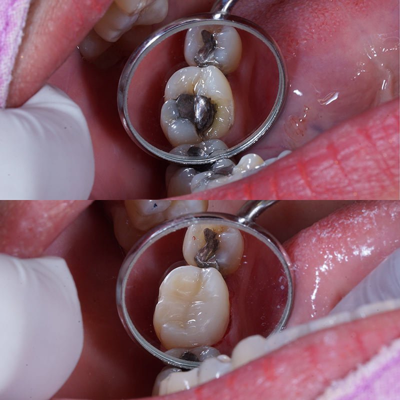 Zahn-Zähne vor und nach dem Auffüllen