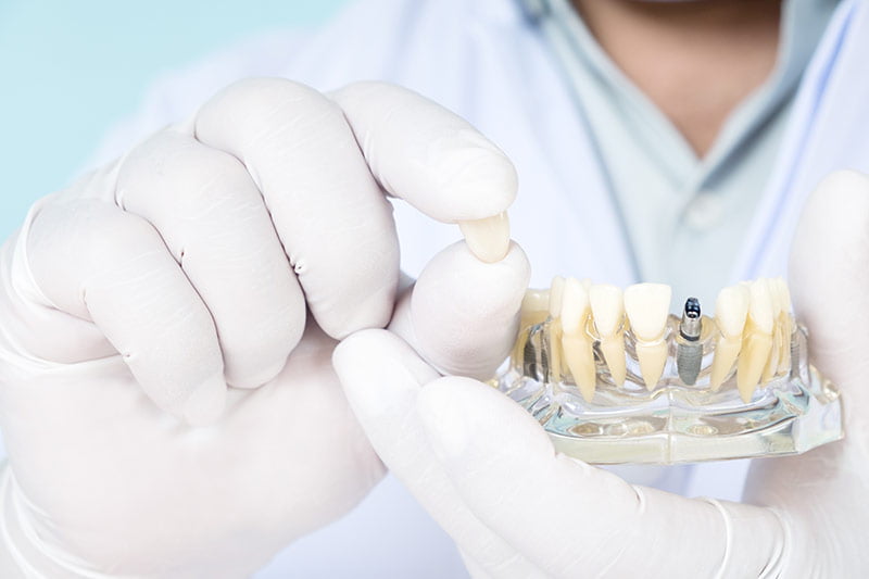 Implantologie Zahnarzt Fürth