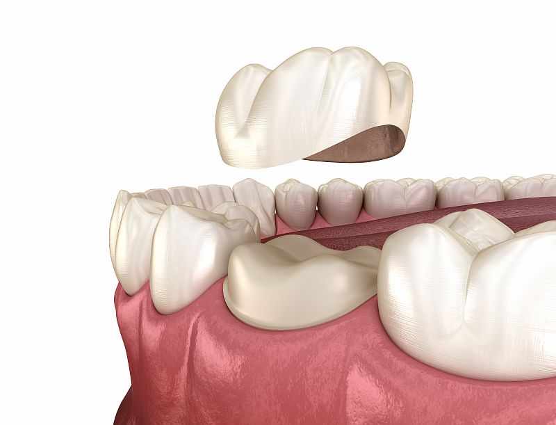 Zahnkrone und Behandlung im Detail