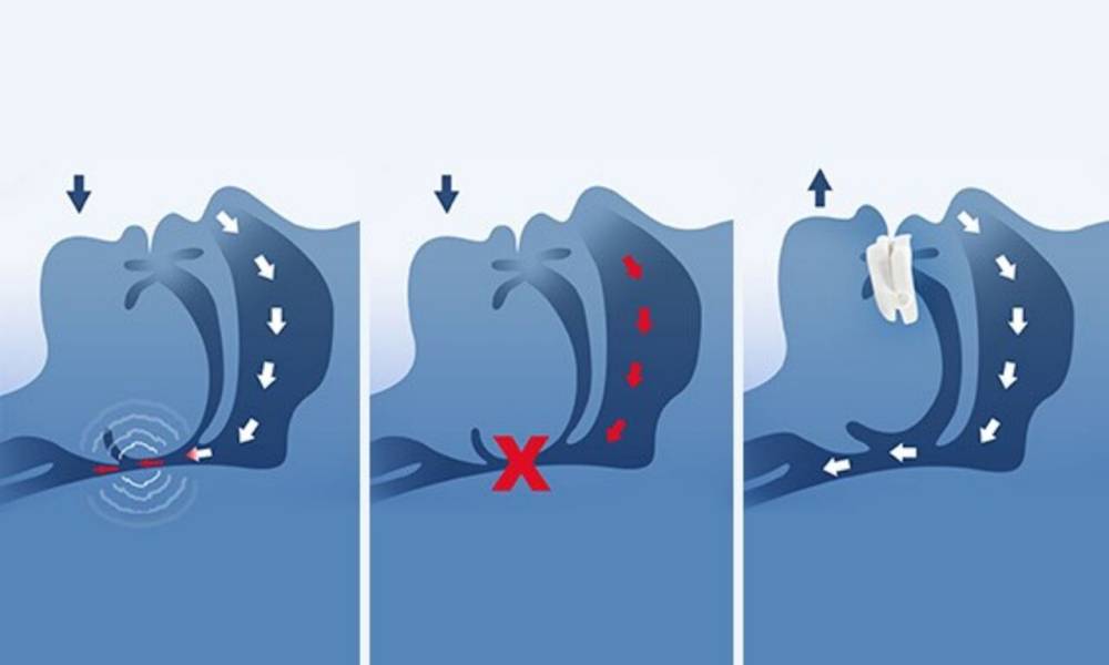 functionality-mandibular-advancement-device